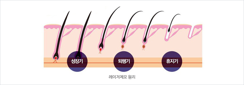 Lovely IPL기계 사진